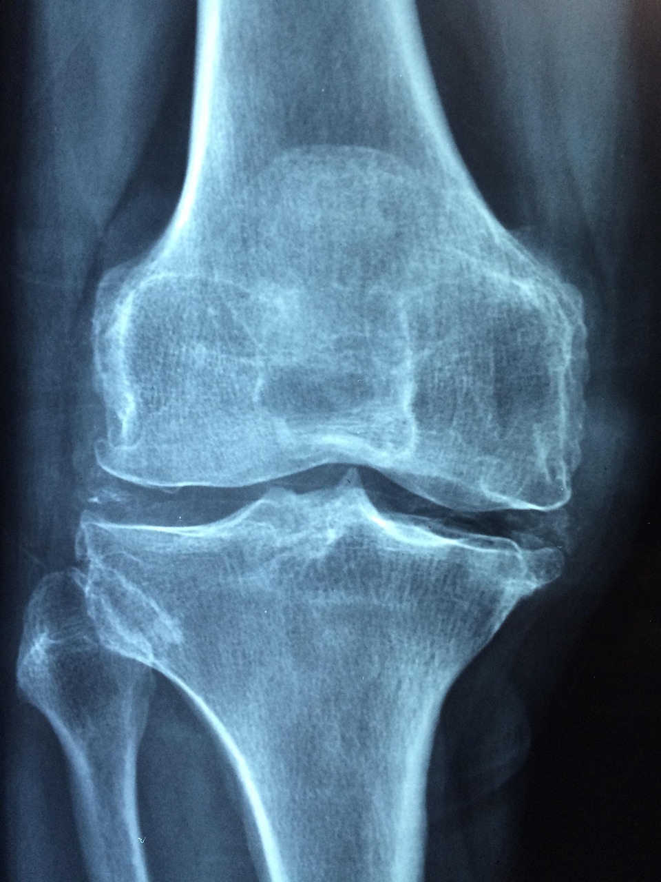 erfahren sie alles über arthrose, ihre ursachen, symptome und behandlungsmöglichkeiten. optimieren sie ihre lebensqualität mit den neuesten informationen zu prävention und therapie der osteoarthritis.